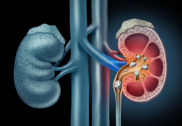 kidney stone treatment in Delhi